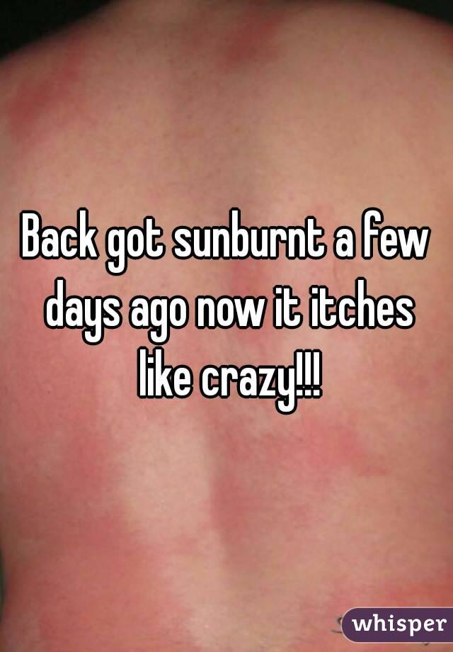 Back got sunburnt a few days ago now it itches like crazy!!!