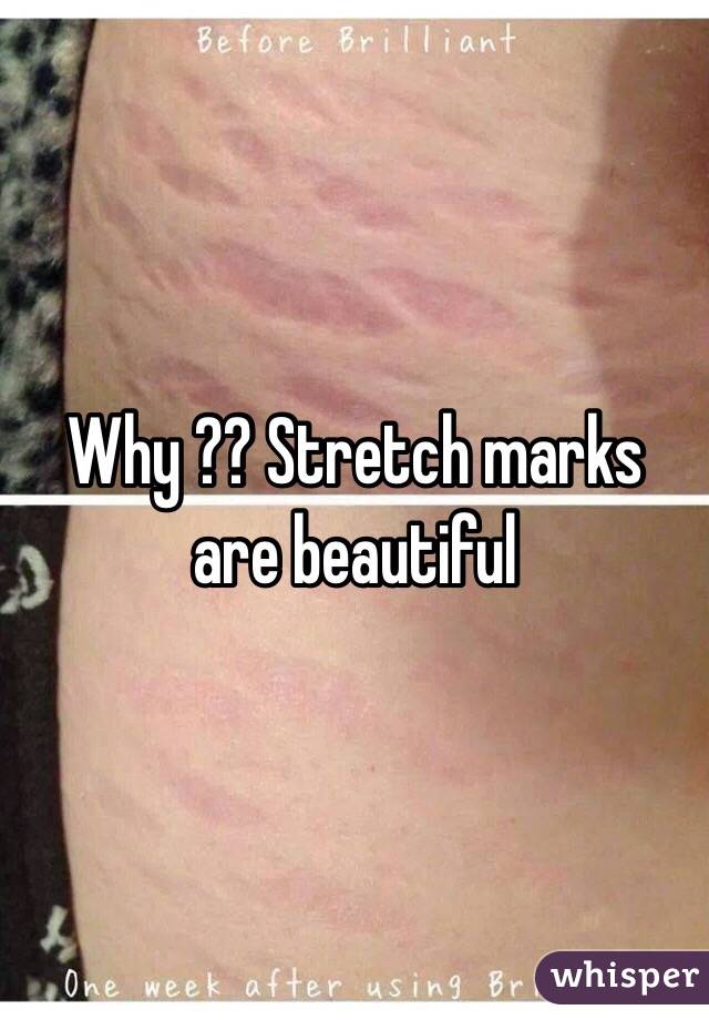 Why ?? Stretch marks are beautiful 