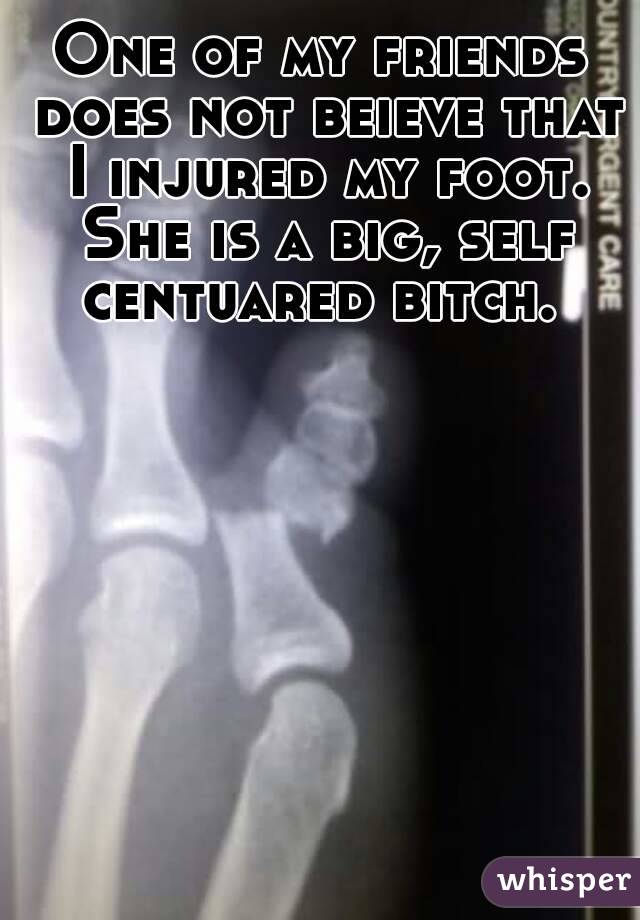 One of my friends does not beieve that I injured my foot. She is a big, self centuared bitch. 