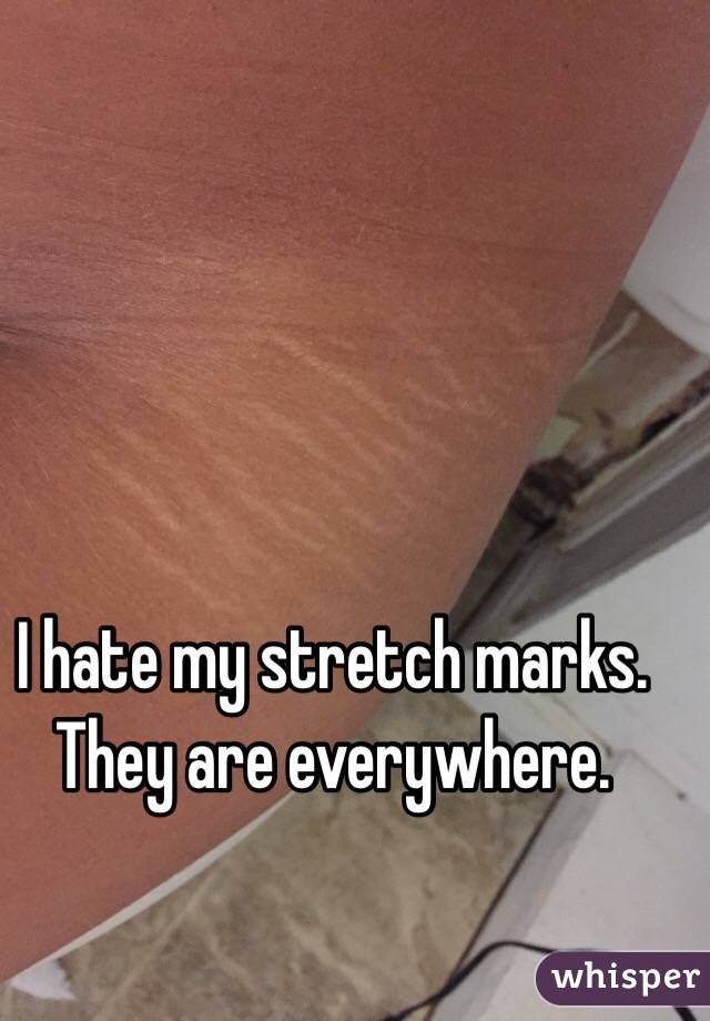 I hate my stretch marks. They are everywhere.