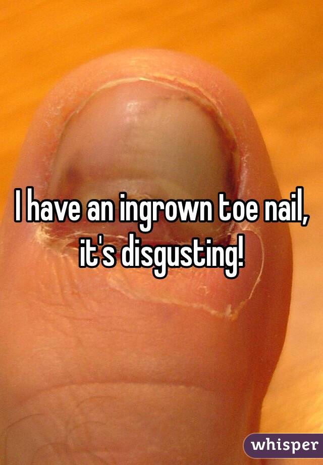 I have an ingrown toe nail, it's disgusting!