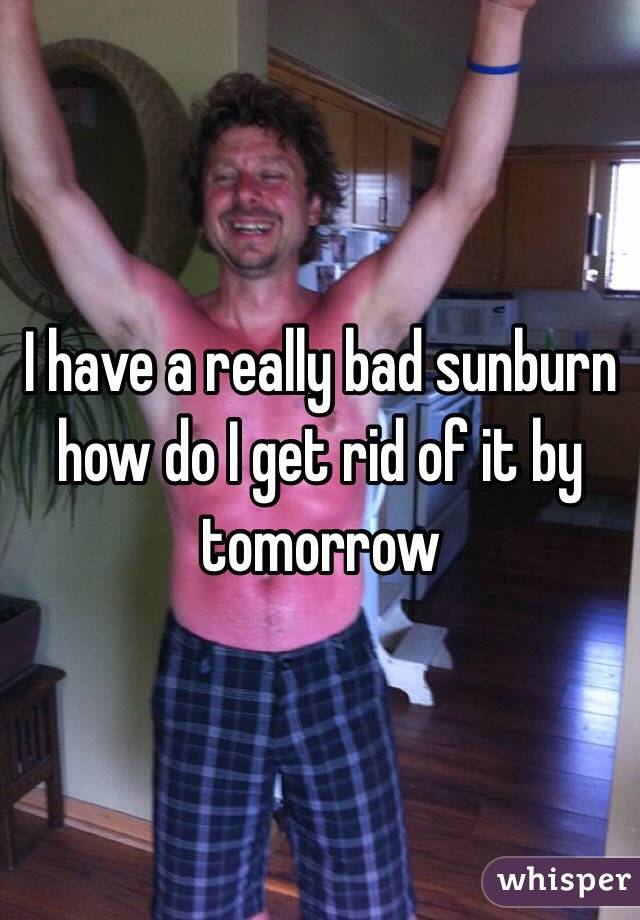 I have a really bad sunburn how do I get rid of it by tomorrow 
