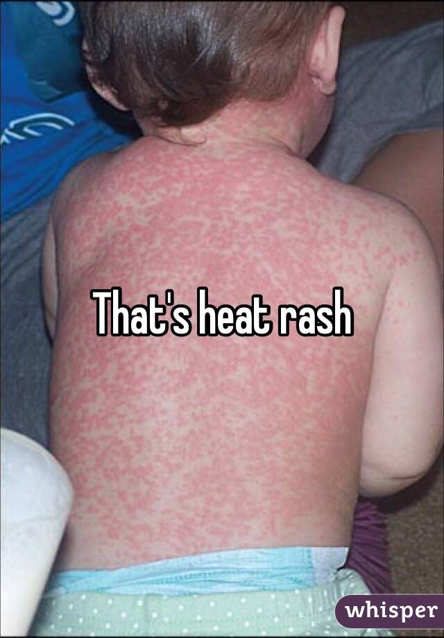 That's heat rash