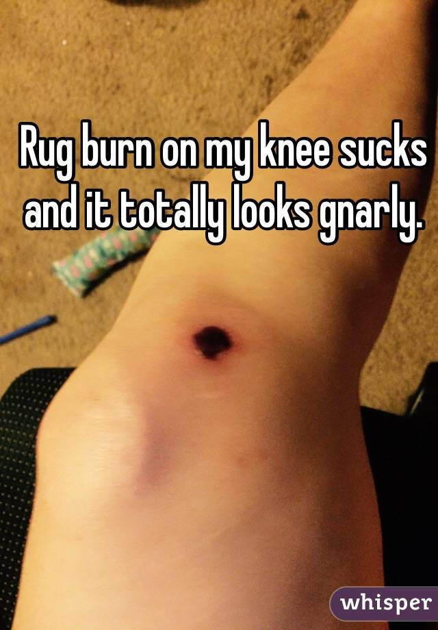 Rug burn on my knee sucks and it totally looks gnarly.