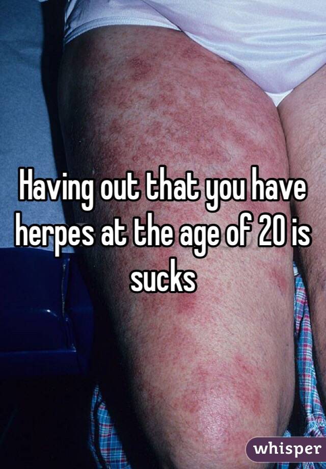 Having out that you have herpes at the age of 20 is sucks 