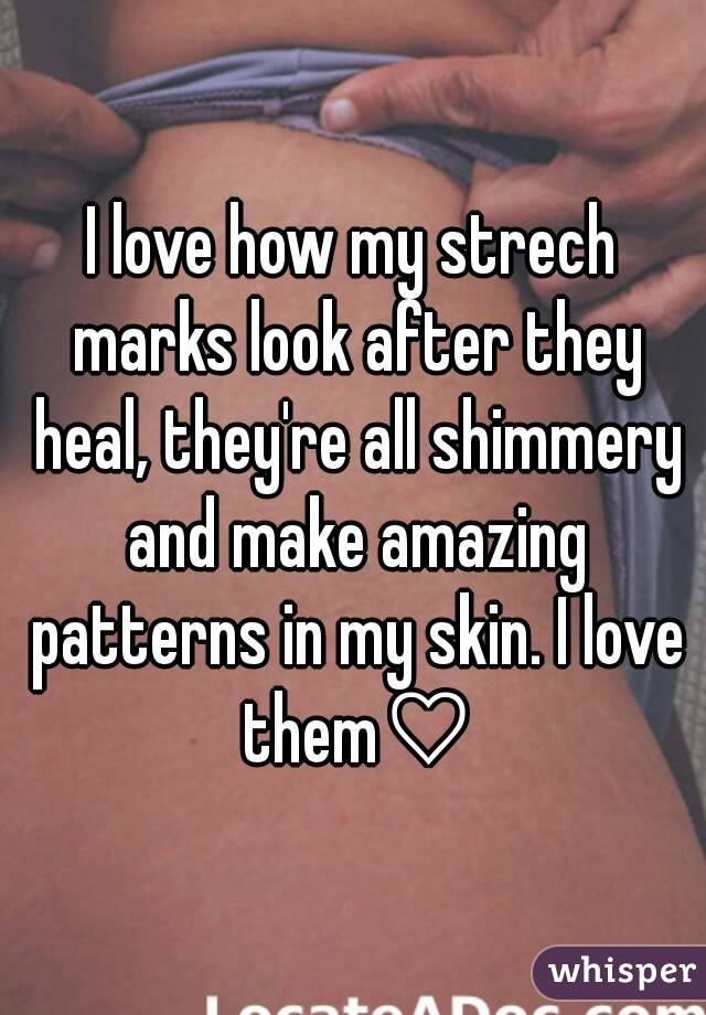 I love how my strech marks look after they heal, they're all shimmery and make amazing patterns in my skin. I love them♡