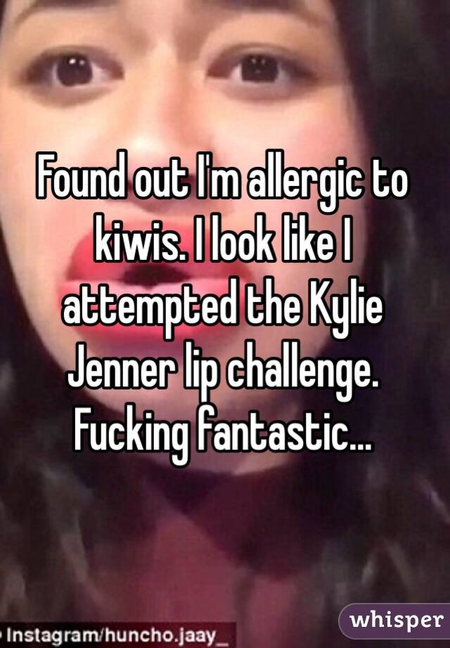 Found out I'm allergic to kiwis. I look like I attempted the Kylie Jenner lip challenge. Fucking fantastic...
