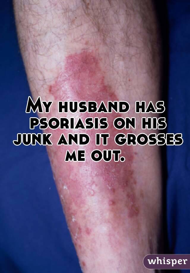 My husband has psoriasis on his junk and it grosses me out. 