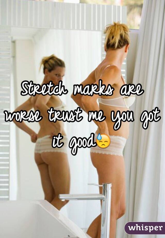 Stretch marks are worse trust me you got it good😓