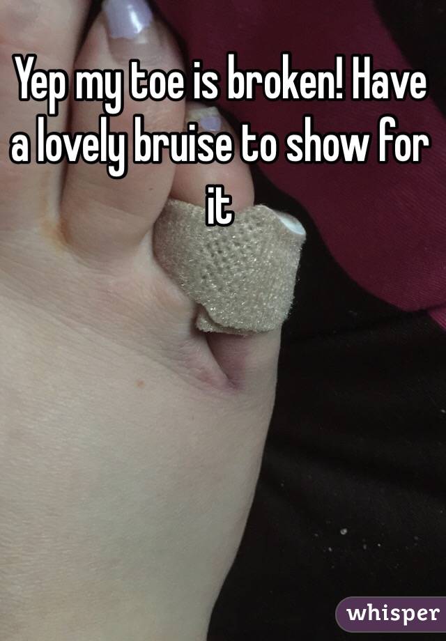 Yep my toe is broken! Have a lovely bruise to show for it