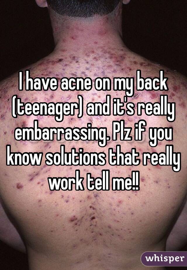 I have acne on my back (teenager) and it's really embarrassing. Plz if you know solutions that really work tell me!! 