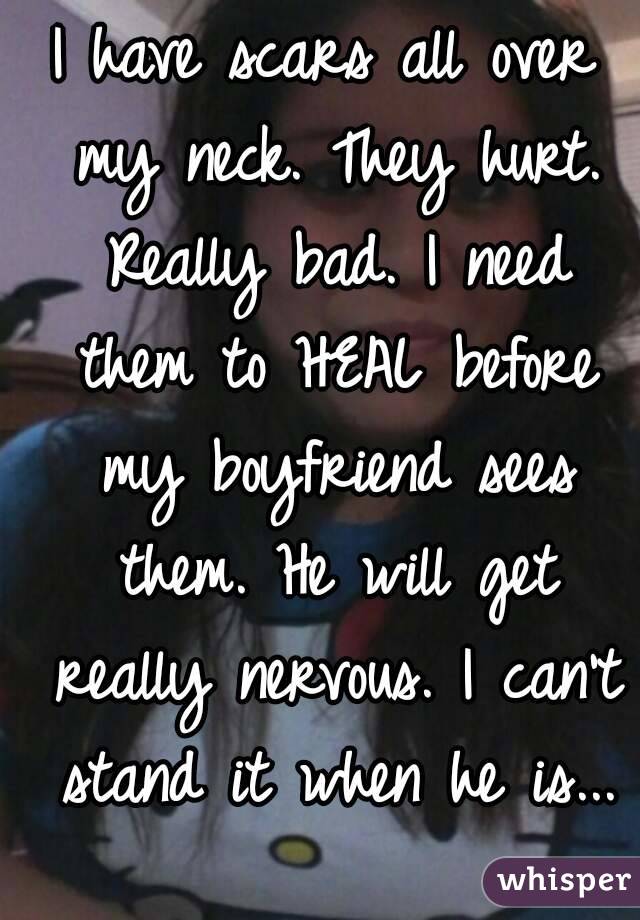 I have scars all over my neck. They hurt. Really bad. I need them to HEAL before my boyfriend sees them. He will get really nervous. I can't stand it when he is...