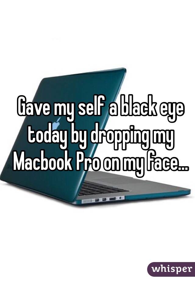 Gave my self a black eye today by dropping my Macbook Pro on my face...