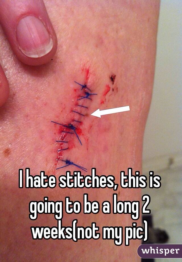 I hate stitches, this is going to be a long 2 weeks(not my pic)