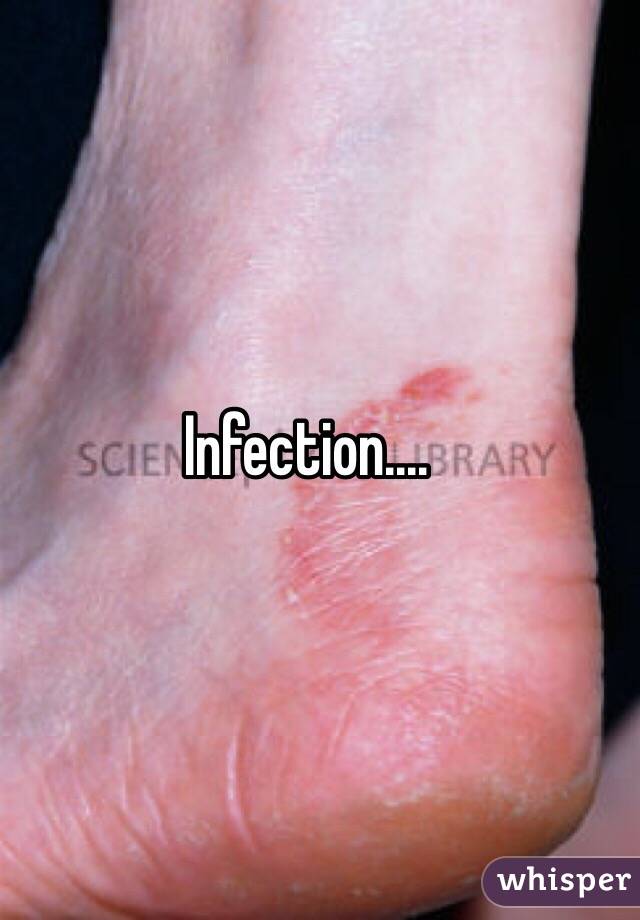 Infection....