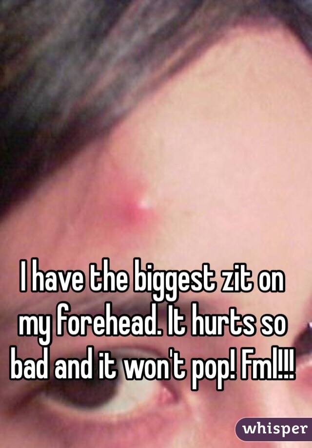 I have the biggest zit on my forehead. It hurts so bad and it won't pop! Fml!!!