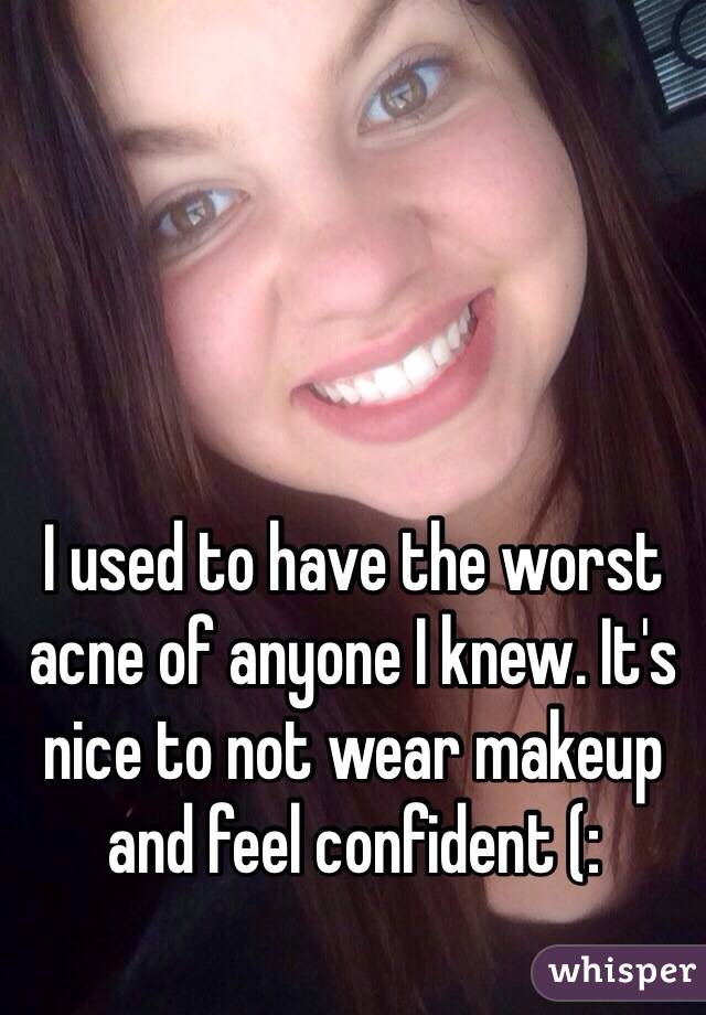 I used to have the worst acne of anyone I knew. It's nice to not wear makeup and feel confident (: