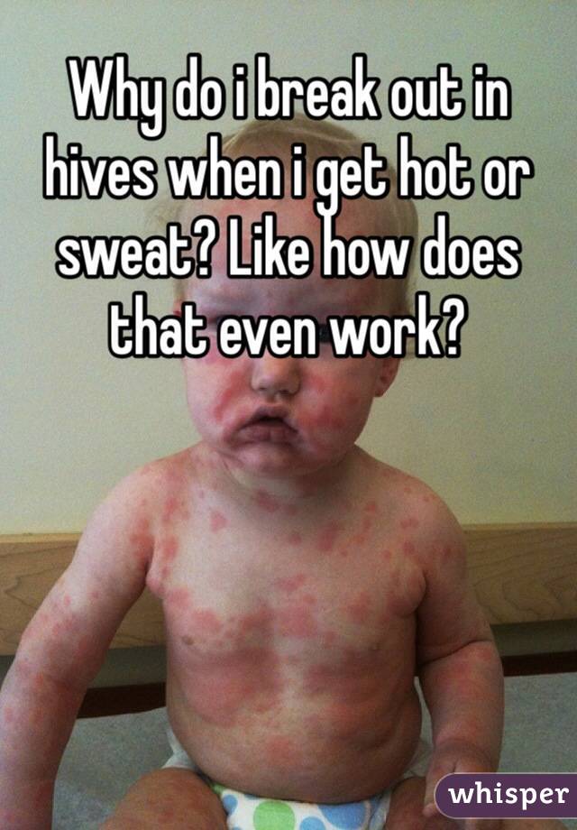 Why do i break out in hives when i get hot or sweat? Like how does that even work? 