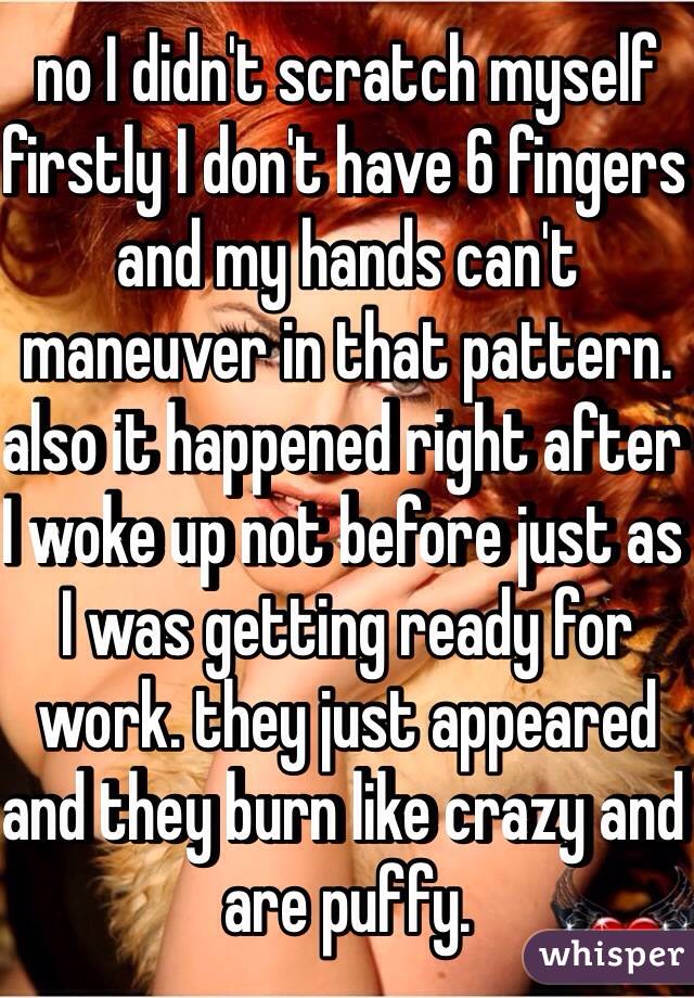 no I didn't scratch myself firstly I don't have 6 fingers and my hands can't maneuver in that pattern. also it happened right after I woke up not before just as I was getting ready for work. they just appeared and they burn like crazy and are puffy.