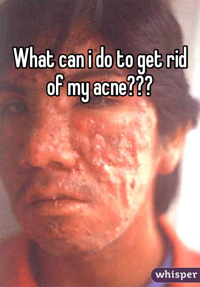 What can i do to get rid of my acne???