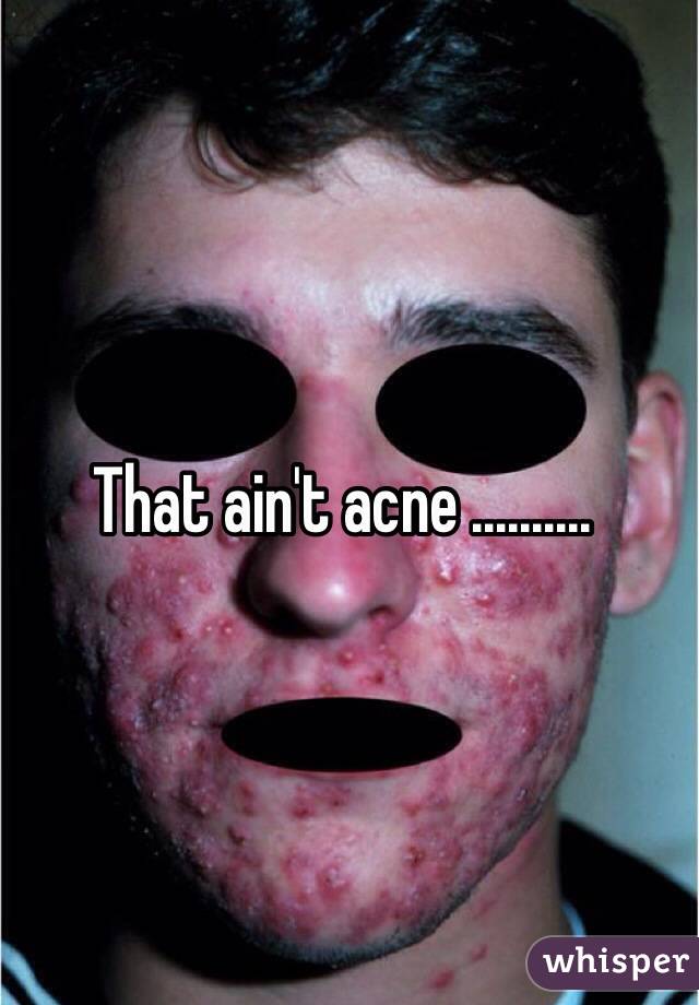 That ain't acne ..........