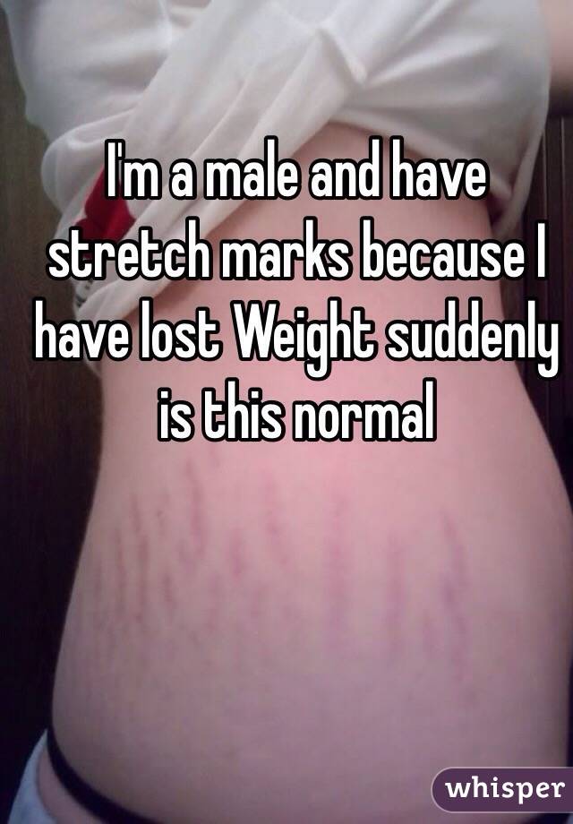 I'm a male and have stretch marks because I have lost Weight suddenly is this normal 