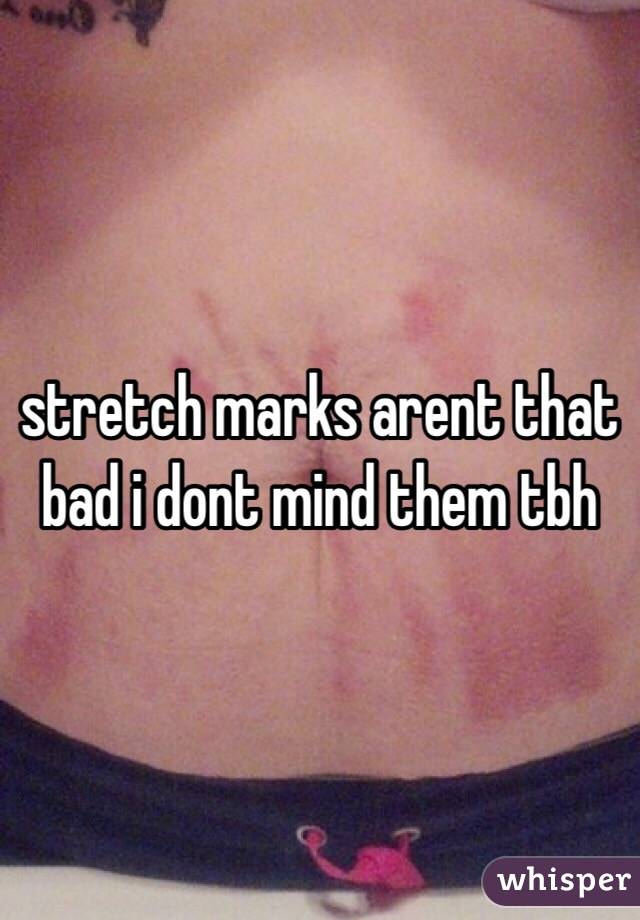 stretch marks arent that bad i dont mind them tbh