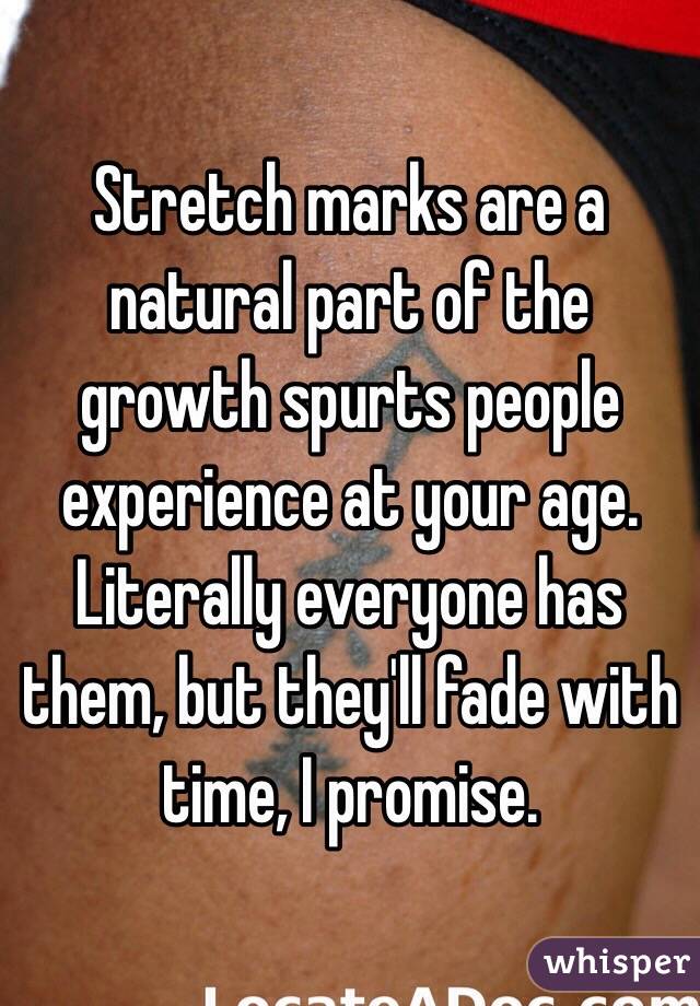 Stretch marks are a natural part of the growth spurts people experience at your age. Literally everyone has them, but they'll fade with time, I promise.