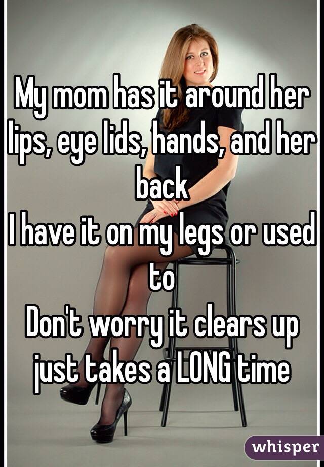 My mom has it around her lips, eye lids, hands, and her back
I have it on my legs or used to 
Don't worry it clears up just takes a LONG time 
