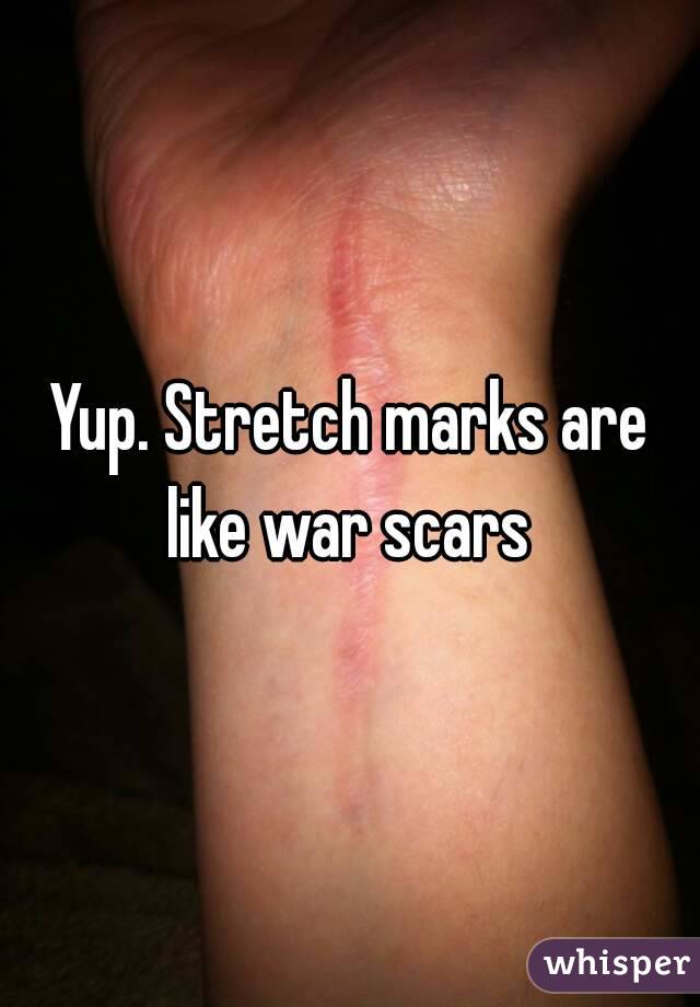 Yup. Stretch marks are like war scars 