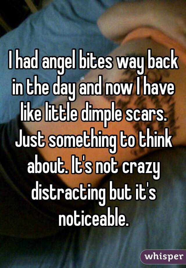 I had angel bites way back in the day and now I have like little dimple scars. Just something to think about. It's not crazy distracting but it's noticeable.