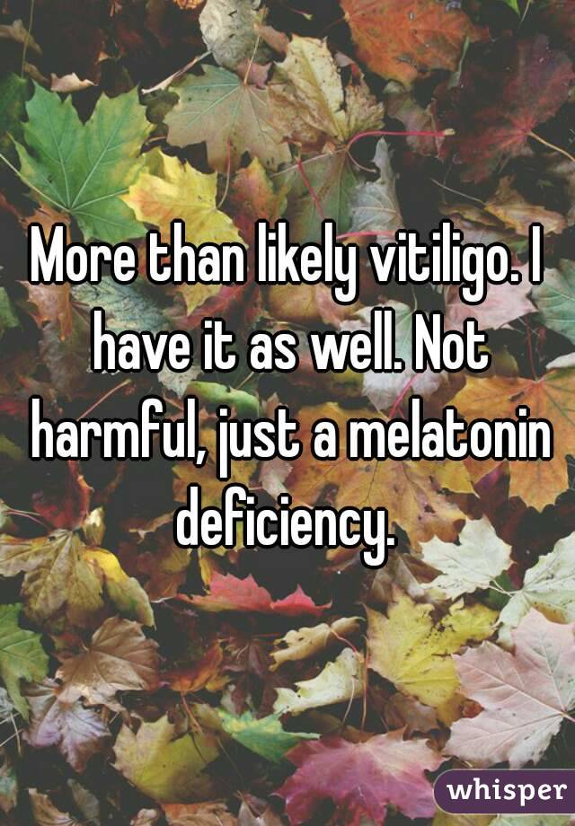 More than likely vitiligo. I have it as well. Not harmful, just a melatonin deficiency. 