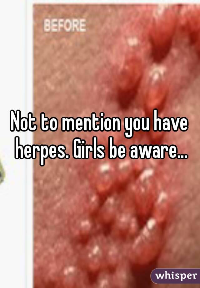 Not to mention you have herpes. Girls be aware...