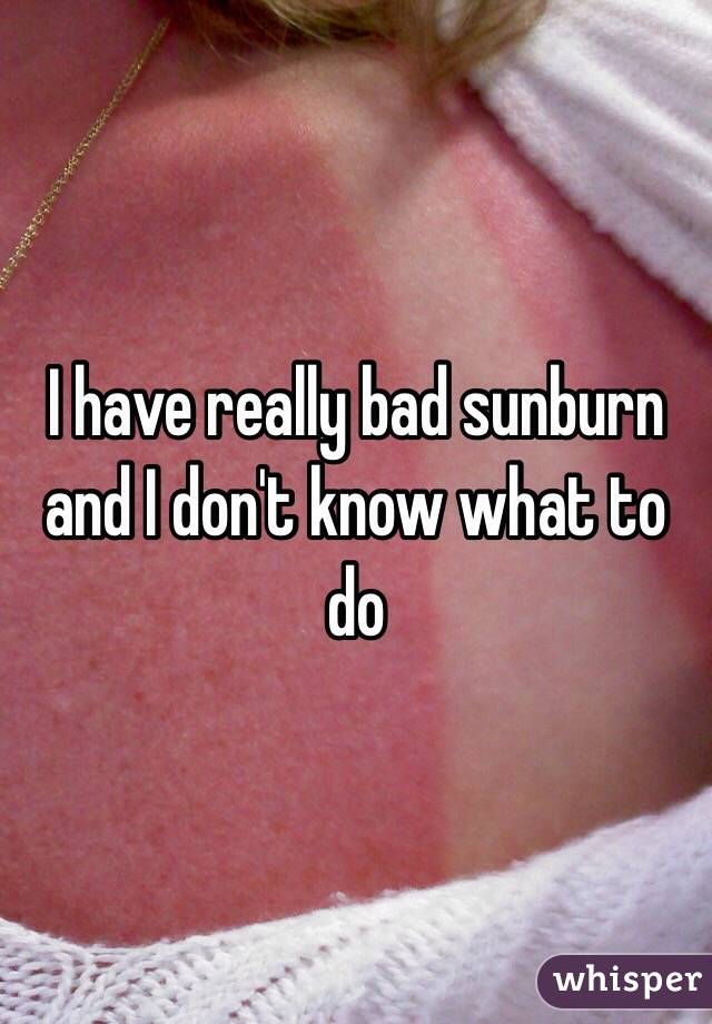 I have really bad sunburn and I don't know what to do