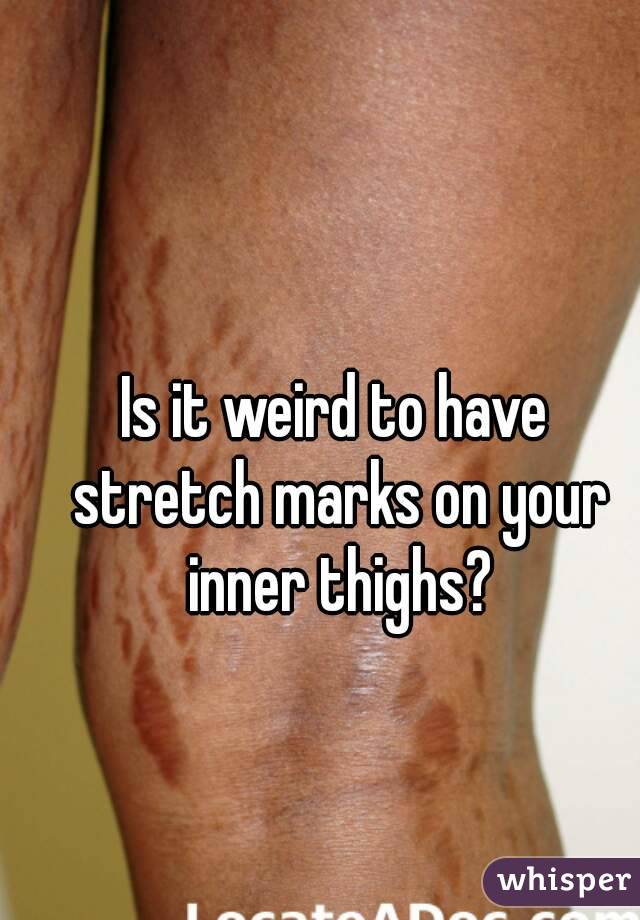 Is it weird to have stretch marks on your inner thighs?