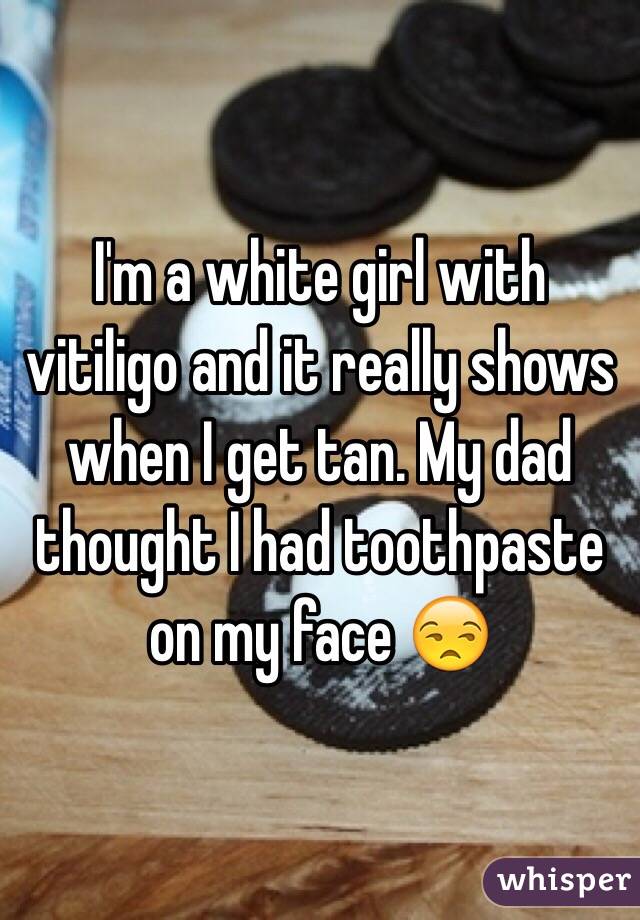I'm a white girl with vitiligo and it really shows when I get tan. My dad thought I had toothpaste on my face 😒