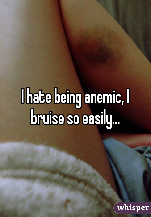 anemic bruise