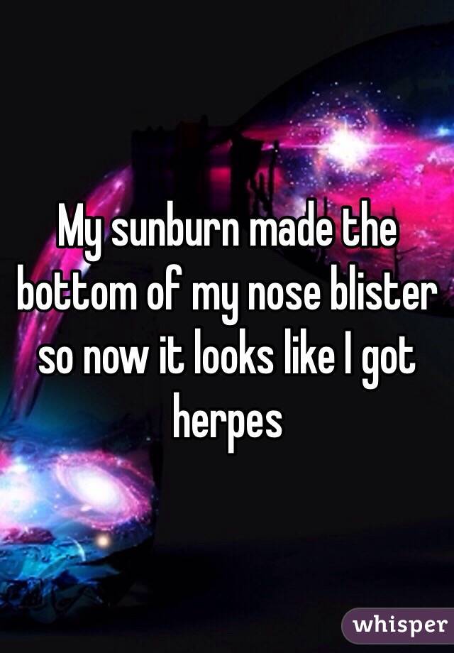 My sunburn made the bottom of my nose blister so now it looks like I got herpes 