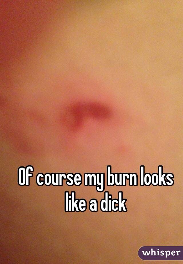 Of course my burn looks like a dick