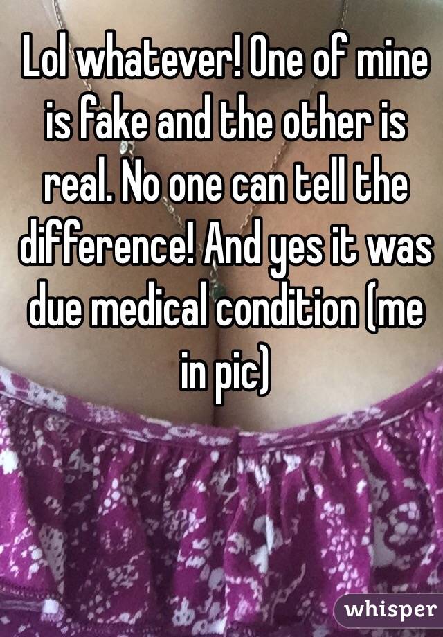 Lol whatever! One of mine is fake and the other is real. No one can tell the difference! And yes it was due medical condition (me in pic)