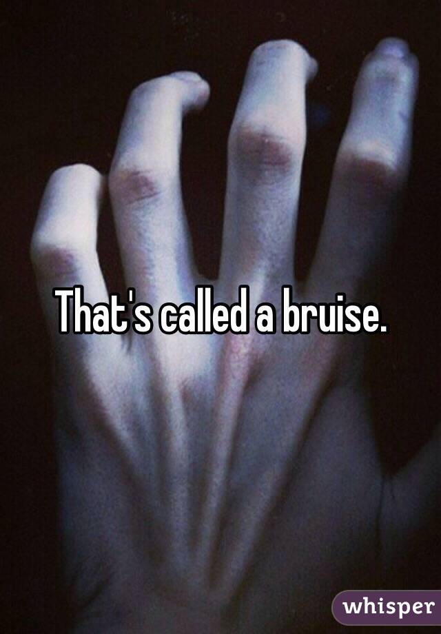 That's called a bruise.