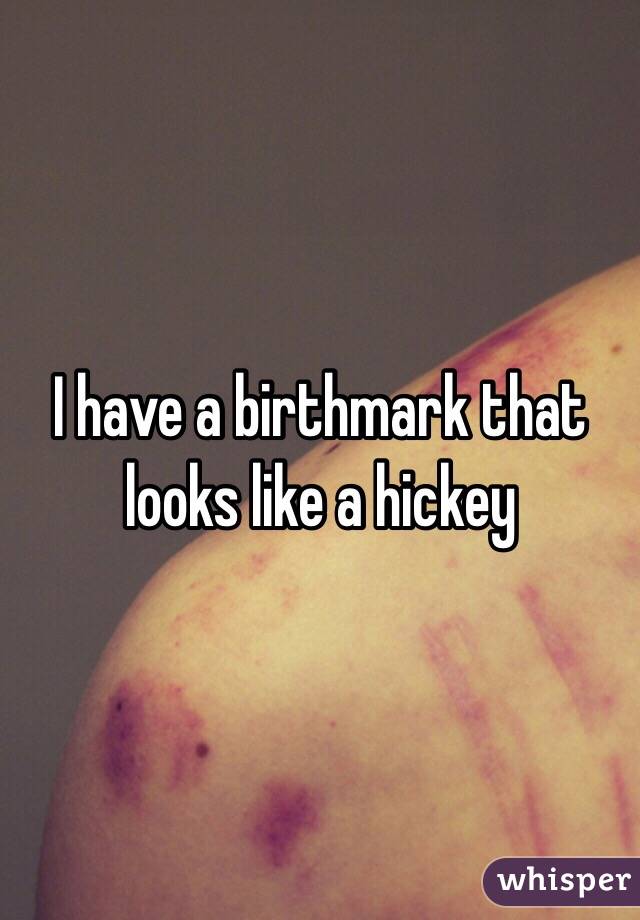 I have a birthmark that looks like a hickey