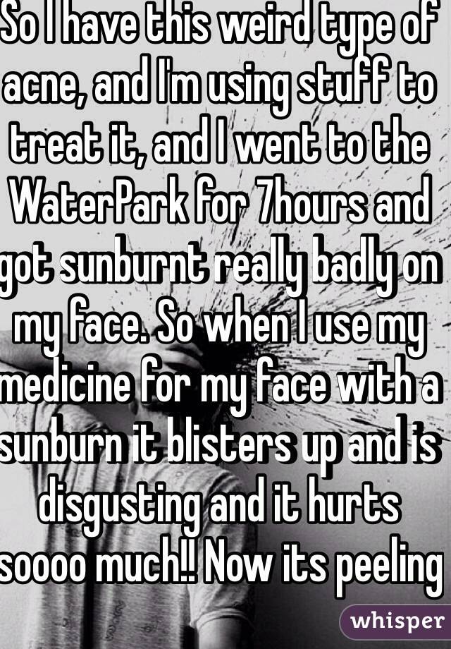 So I have this weird type of acne, and I'm using stuff to treat it, and I went to the WaterPark for 7hours and got sunburnt really badly on my face. So when I use my medicine for my face with a sunburn it blisters up and is disgusting and it hurts soooo much!! Now its peeling