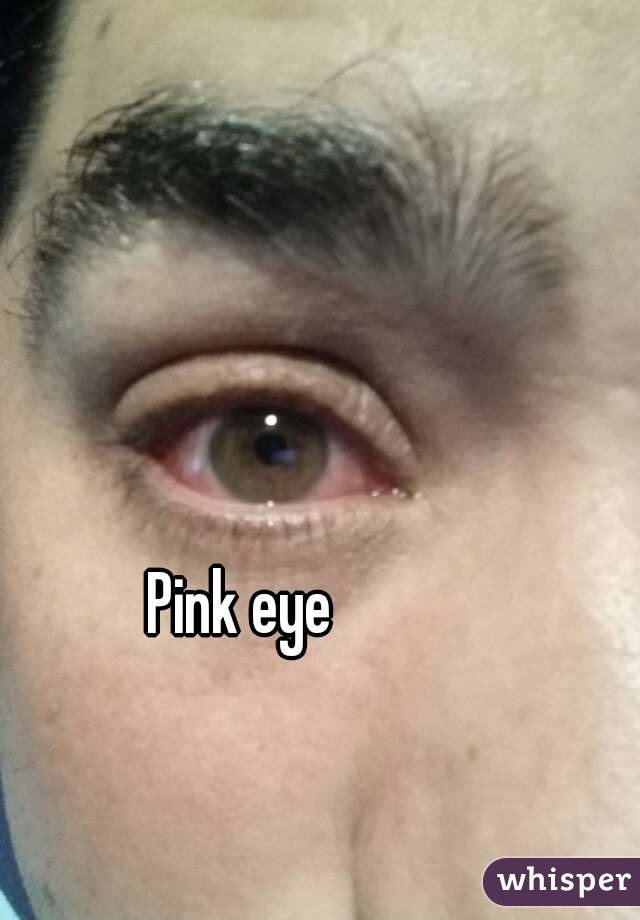 Pink eye