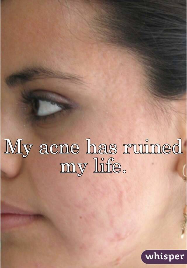 My acne has ruined my life. 