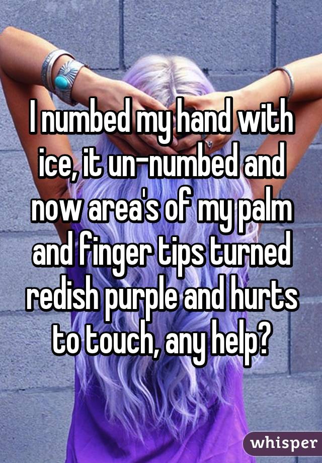 I numbed my hand with ice, it un-numbed and now area's of my palm and finger tips turned redish purple and hurts to touch, any help?