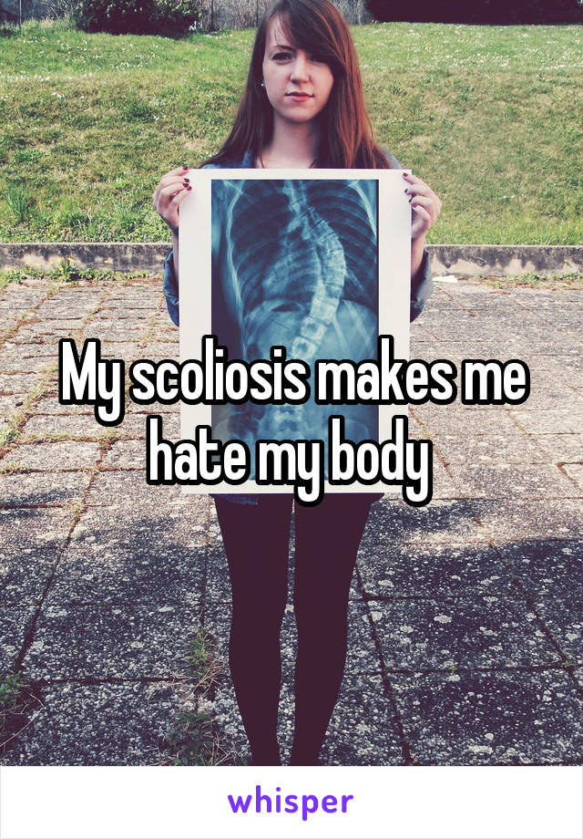 My scoliosis makes me hate my body 
