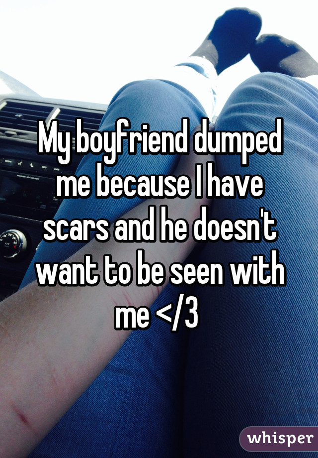 My boyfriend dumped me because I have scars and he doesn't want to be seen with me </3 