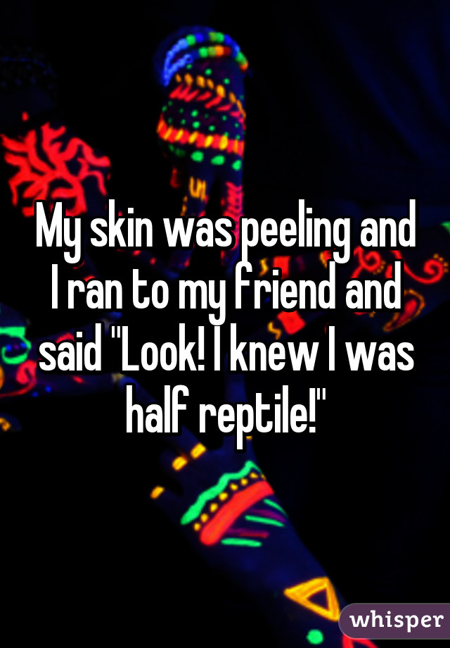 My skin was peeling and I ran to my friend and said "Look! I knew I was half reptile!"