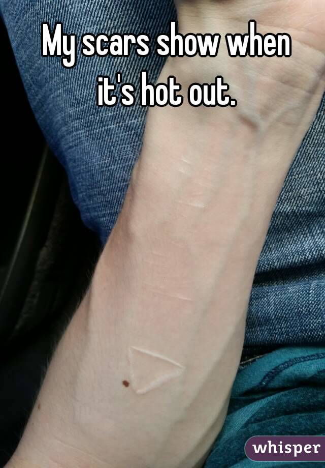 My scars show when
it's hot out.